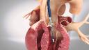Cardiac Surgery Devices Market Confronts High Costs and Workforce Shortage in Developing Countries
