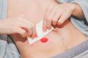 OstomyStoma Care Market Confronts Social Stigma Low Awareness and Poor Healthcare Infrastructure