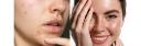 Anti-Acne Cosmetics Market scenario tracking pharmaceutical collaborations and clinical dermatology research