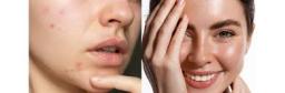 Anti-Acne Cosmetics Market scenario tracking pharmaceutical collaborations and clinical dermatology research