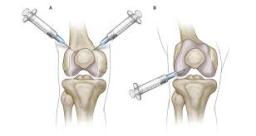 Viscosupplementation Market Adoption Trends