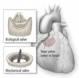 Prosthetic Heart Valves Market Industry Outlook