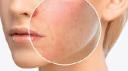 Allergy Care Market Trends Highlighting Innovation, Patient Engagement, and Regional Growth Opportunities