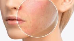 Allergy Care Market Trends Highlighting Innovation, Patient Engagement, and Regional Growth Opportunities