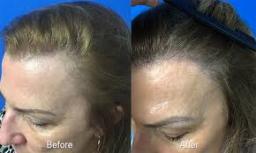 Hair Restoration Market witnessing significant adoption of PRP and regenerative hair treatments