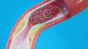 Atherosclerosis Drugs Market competitive landscape exploring key players strategies and innovation dynamics
