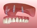 Global Fixed Denture Market to Reach USD 5.3 Billion by 2032 | CAGR 4.21% | USD 3.81 Billion Valued in 2024