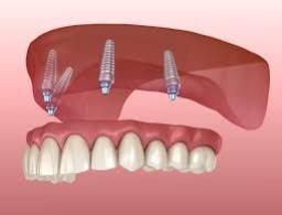 Global Fixed Denture Market to Reach USD 5.3 Billion by 2032 | CAGR 4.21% | USD 3.81 Billion Valued in 2024