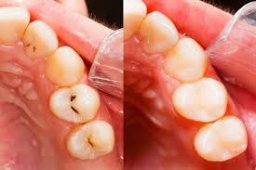 Tooth Filling Materials Market is likely to register CAGR of 5.6% through 2029