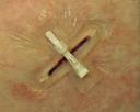 Non-invasive Surgical Wound Closure Market latest R&D developments driving future market breakthroughs