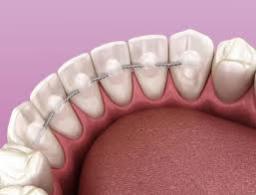 Orthodontic Retainers Market consumer insights revealing preferences for comfort and aesthetic appeal 