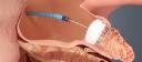 Atrial Fibrillation Device Market Future Outlook: Trends, Opportunities, and Growth Prospects