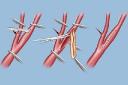 Vascular Patches Market Outlook Driven by Cardiovascular Disease Rise and Surgical Advancements Worldwide