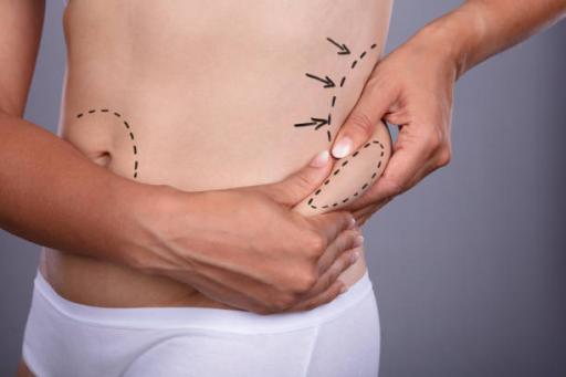MILA Minimal Invasive LipoAbdominoplasty